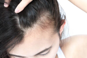 Struggling with Hair Growth? Discover How to Achieve Longer, Thicker Hair in 30 Days!