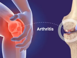 Arthritis