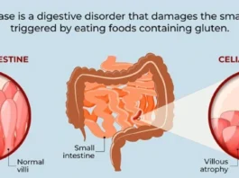 Celiac Disease