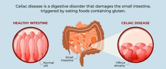 Celiac Disease