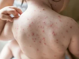 Chickenpox, medically known as varicella, is a highly contagious viral Disease