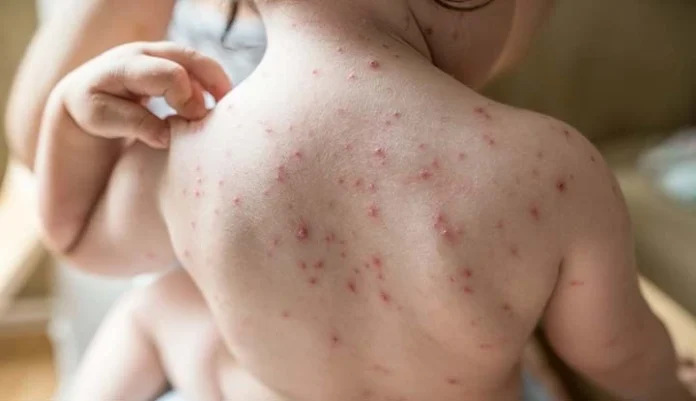 Chickenpox, medically known as varicella, is a highly contagious viral Disease