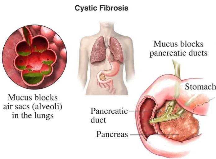 Genetic Basis of Cystic Fibrosis Symptoms and Complications