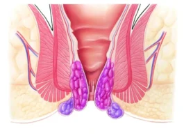 Hemorrhoidal 
