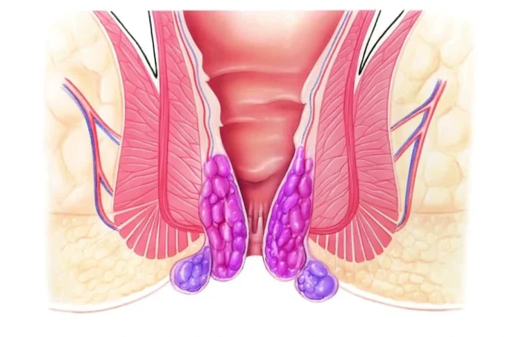 Hemorrhoidal 