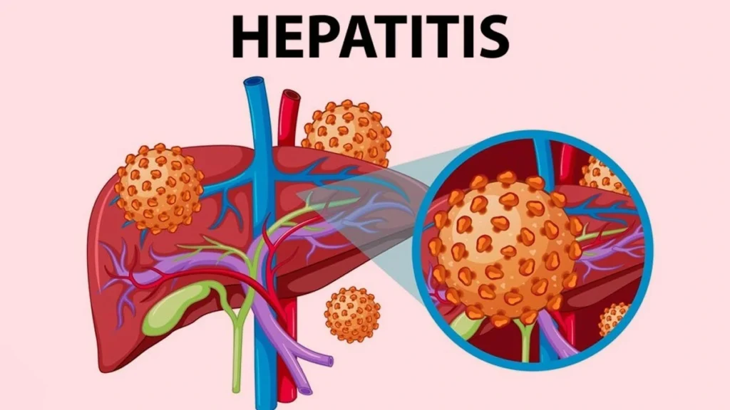 Hepatitis