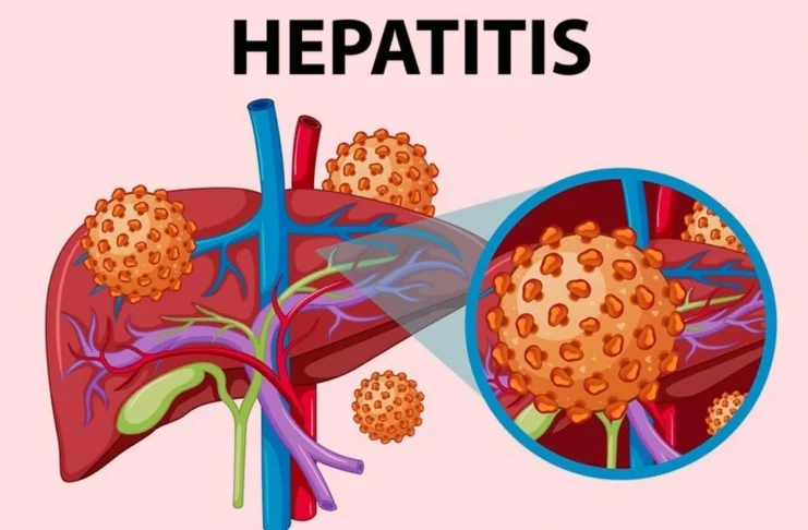 Hepatitis