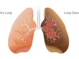 Lung Cancer