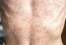 Measles, is a highly contagious viral disease that primarily affects the respiratory system. Measles