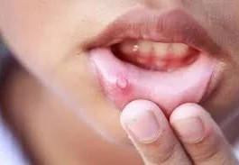Mouth ulcers