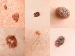 Skin Cancer Skin Cancer