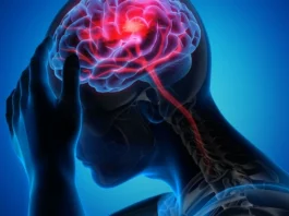 Understanding Stroke