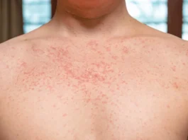 measles