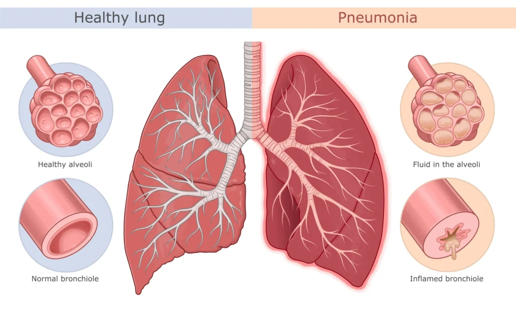 pneumonia