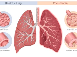 pneumonia