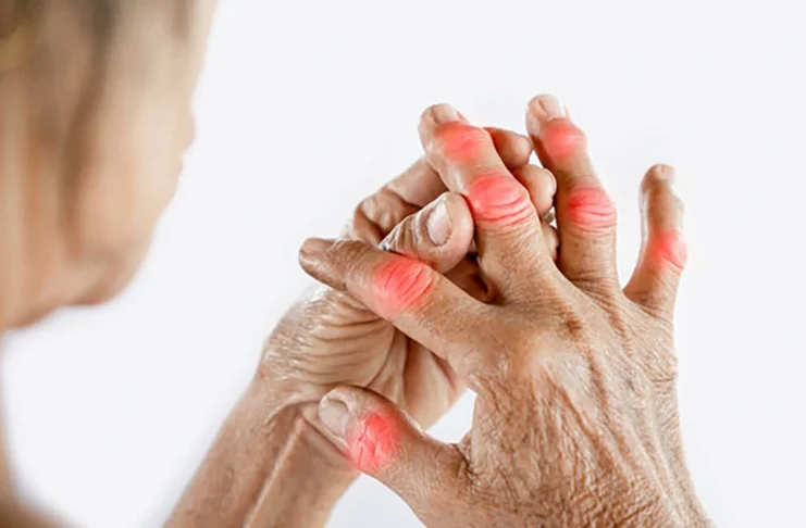rheumatoid arthritis