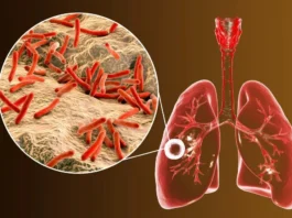 tuberculosis