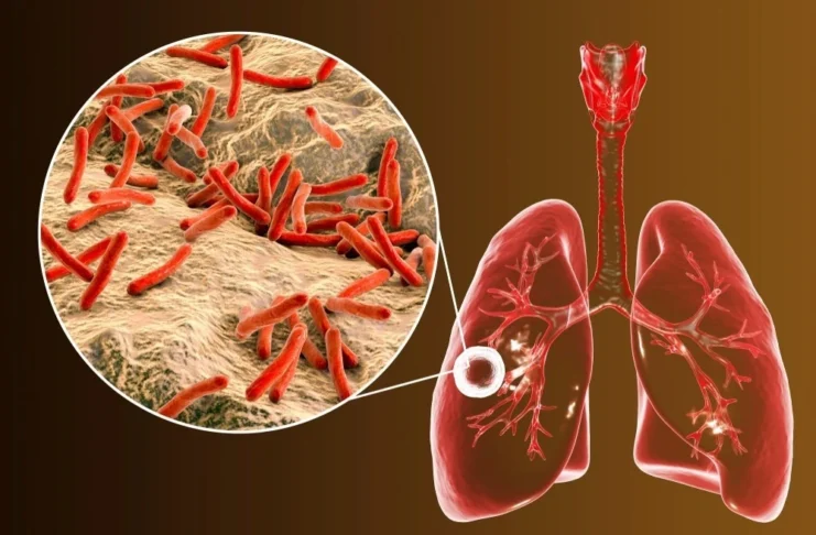 tuberculosis